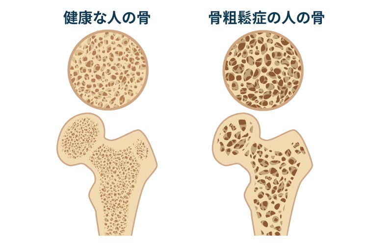 骨粗鬆症